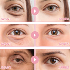 Patches contour des yeux à micro-aiguilles – Réduction visible des cernes