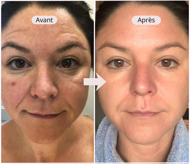 Patch contour des yeux à micro-aiguilles – Réduction visible des cernes